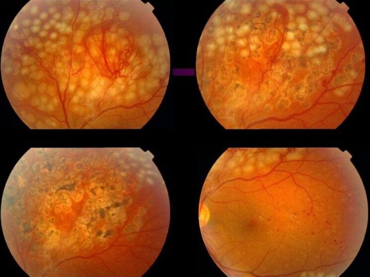 Retinopatija dėl hipertenzijos